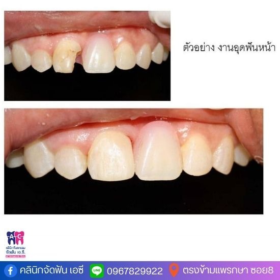 คลินิกทำฟัน อุดฟัน ขูดหินปูน สมุทรปราการ คลินิกทําฟัน สมุทรปราการ  คลินิกอุดฟัน สมุทรปราการ  คลินิก ถอนฟัน สมุทรปราการ  คลินิกทันตกรรม ใกล้ฉัน  คลินิกทันตกรรมใกล้ฉัน  คลินิกทันตกรรมแพรกษา  คลินิกจัดฟัน สมุทรปราการ ราคาถูก 